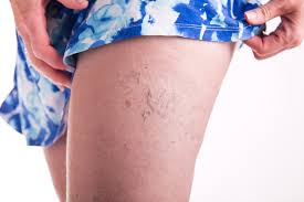 Home Treatment Spider Veins