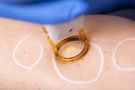 Laser Treatment for Veins