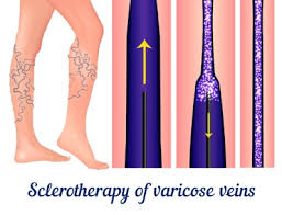 Varicose Veins  Fayette Surgical Associates