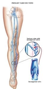 graphic demonstrating primary varicose veins