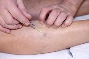 sclerotherapy near me