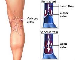 Vein Clinic