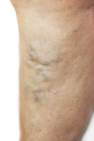 A photo of a varicose vein in the calf