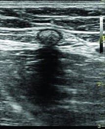 Ultrasound image, leg veins, glue varicose vein, treatment,