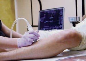 varicose vein treatment