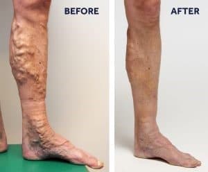 Varicose Veins Men