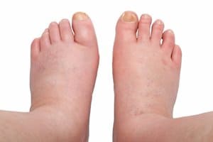 A picture of edema (swelling) in feet