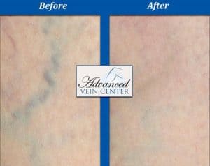 varicose veins treatment