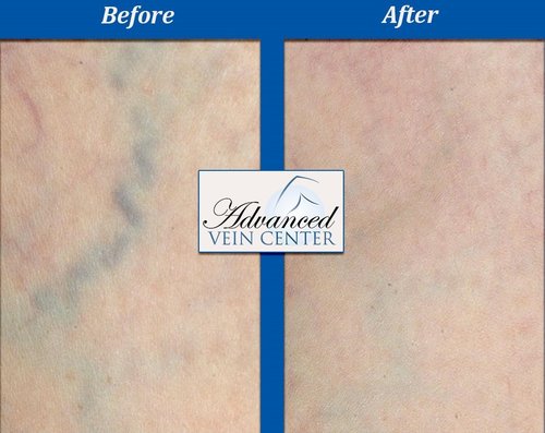 vein doctor near me, before and after vein treatment in Pittsburgh pa