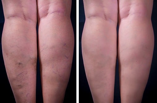 10 Myths About Varicose Veins - Modern Heart and Vascular