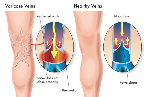 Blood flow, open valve, normal vein, varicose veins, diagram, vein structure, legs, varicose veins, Unsightly leg veins, bulging veins, spider veins, top specialist