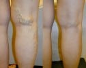 What Causes Varicose Veins?