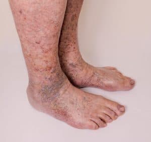 Varicose Leg Veins In Men - Treatment In Pittsburgh - Vein Center