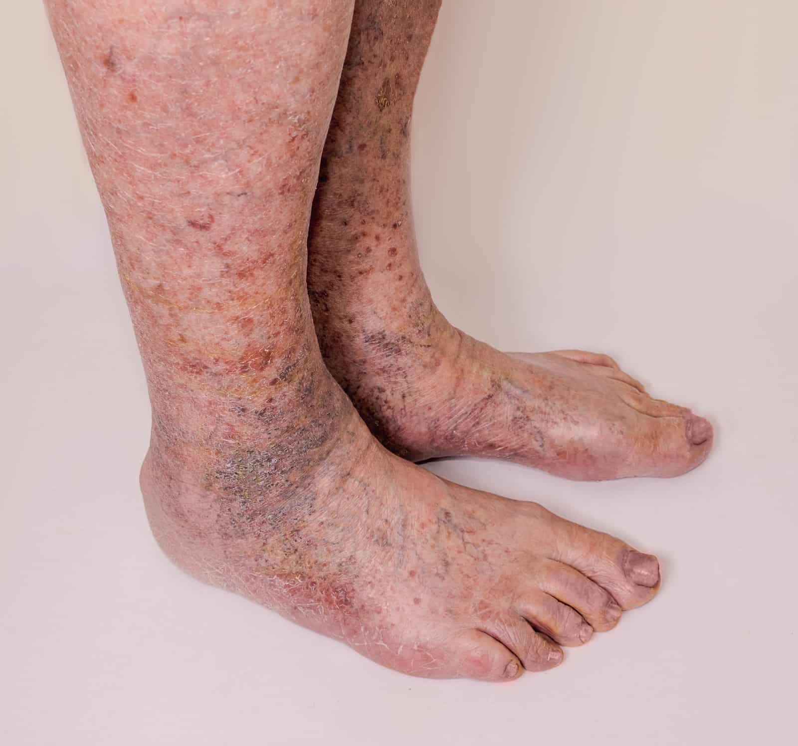 What Causes Small Red Veins On Ankles