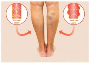 A comparison of normal leg veins and abnormal leg veins using a photo and a graphic representation 