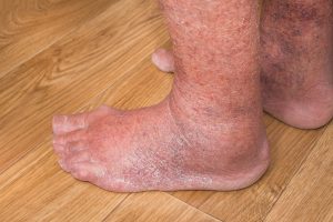 swollen legs