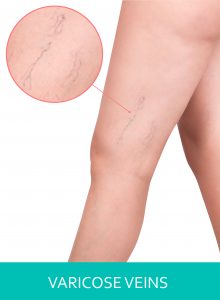 Causes of Varicose Veins