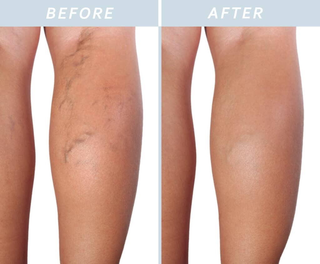 Before and after photos of varicose vein  phlebectomy treatment