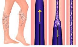 Venaseal vein graphic