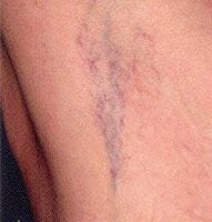 Is There Anything I Can Do to Prevent Spider Veins? - Vein Center of  Brinton Lake