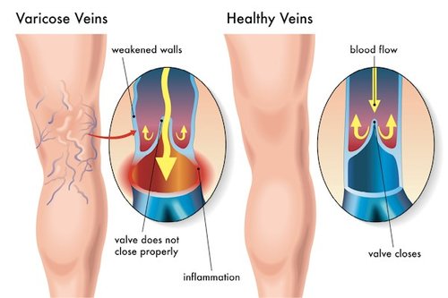 Pictures of the back of calves demonstrating healthy vein vs a varicose vein